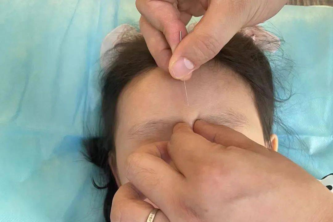 近视形成的重要原因是用眼不卫生造成眼部睫状肌的疲劳,痉挛,而针灸