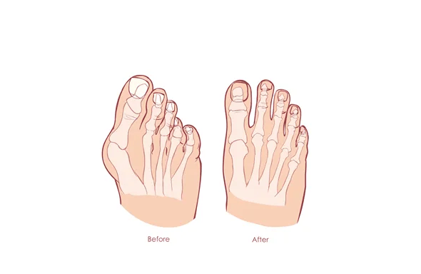 儿童也会拇指外翻吗?如何在家改善?