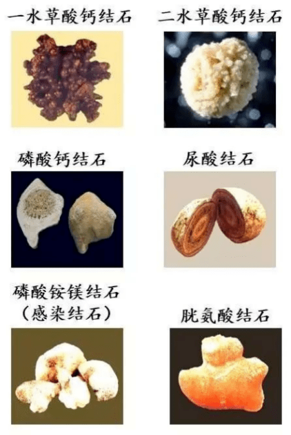 肾结石种类图解图片