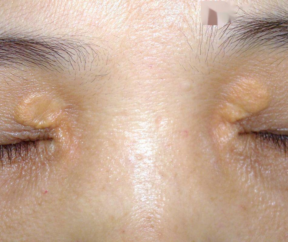 睑黄疣,是脂质,沉积于眼睑部位,而引起的皮肤的黄色,或橙色的斑块