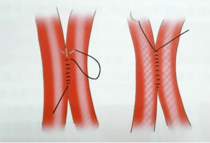 颈动静脉瘘图片