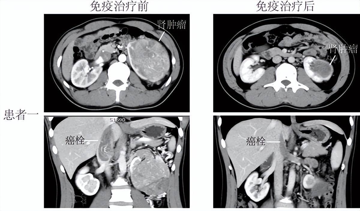 中南大学湘雅二病院胜利救治两例复杂肾癌并腔静脉癌栓患者