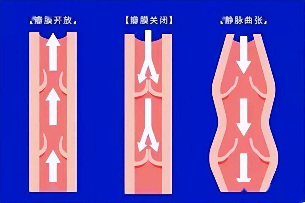 下肢静脉瓣图片