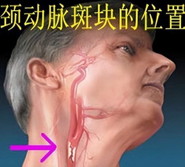 血管斑块分2种:1种更容易脑梗死!记住2个字,看完您也能区分!