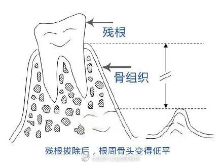 老年人的残根牙可以不拔吗?_牙根_评估_处理