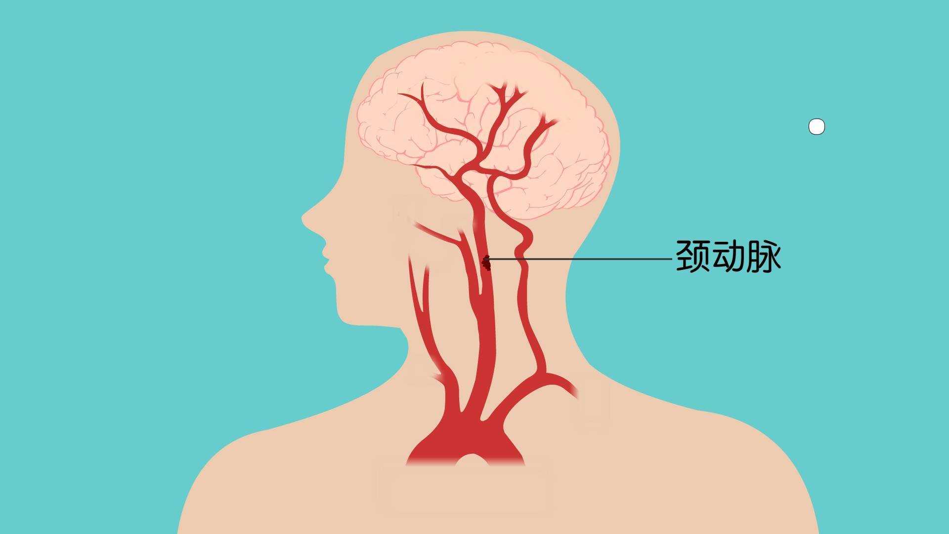 颈动脉超声报告单图片图片