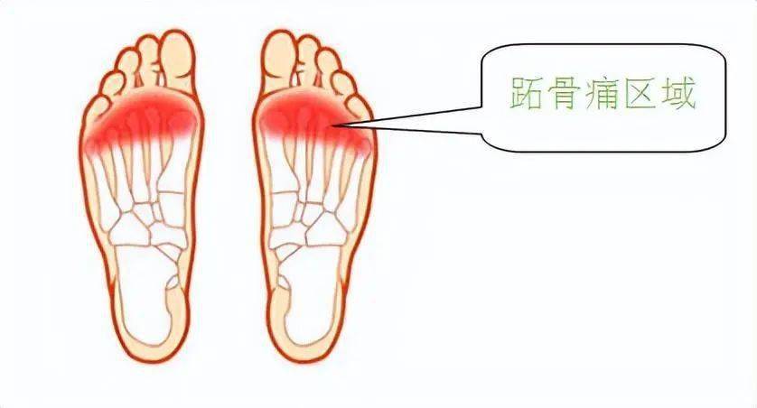 跖,脚面上接近脚趾的部分,跖痛症指的是跖骨头挤压趾神经所引起跖部