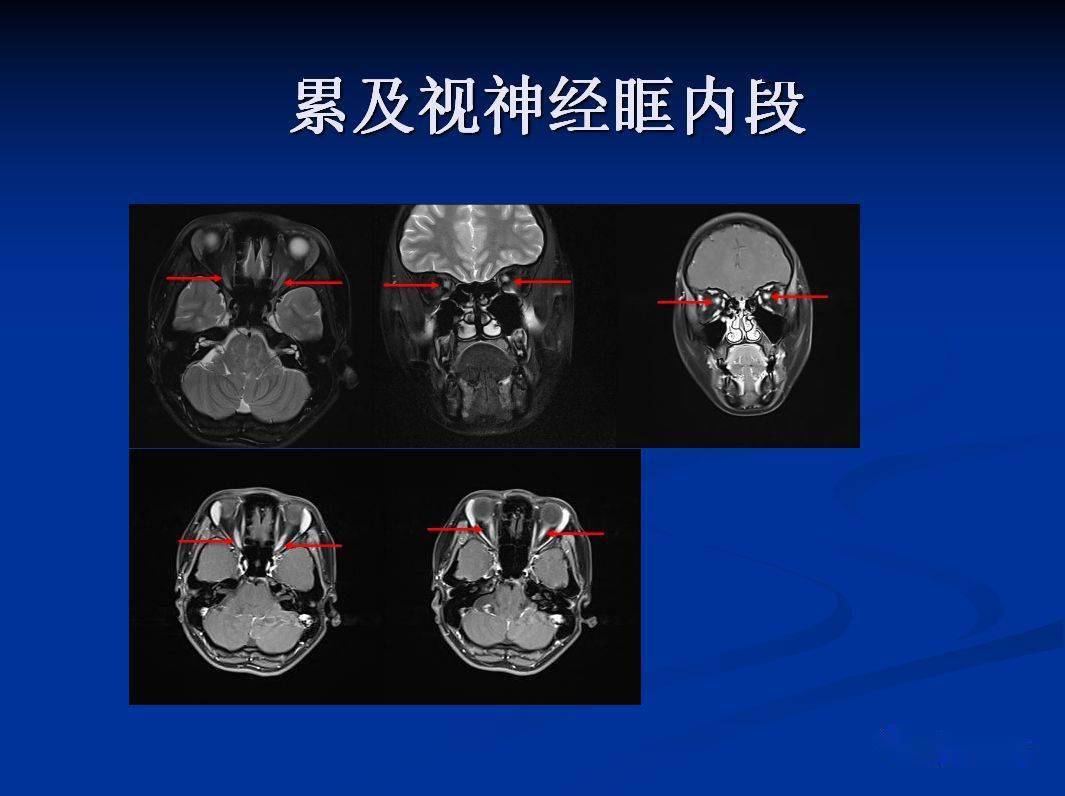 视神经mr图片