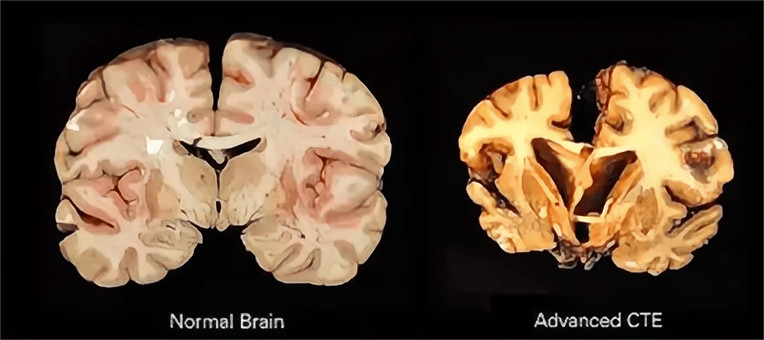 烹煮都杀不死的朊病毒,感染后究竟会有多恐怖?_大脑_蛋白_动物