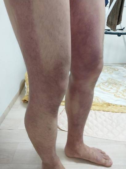 梨泰院踩踏事故幸存者公开腿部瘀伤照片:这是我卡住时承受的压力_挤压_遇难者_压迫