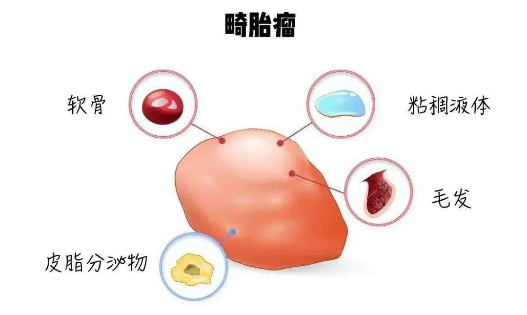 卵巢畸胎瘤是由於胚胎時期生殖細胞分化異常形成的一種常見的卵巢生殖