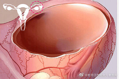 【科普】发现卵巢囊肿，我们该怎么办？
                
                 