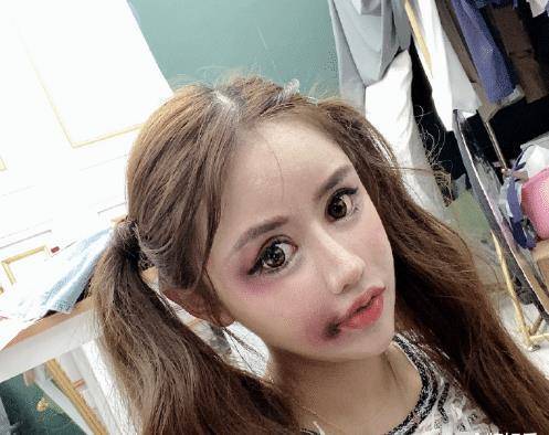 原创13岁开始整容的网红自曝整形失败脸部大浮肿嘴角都发紫了