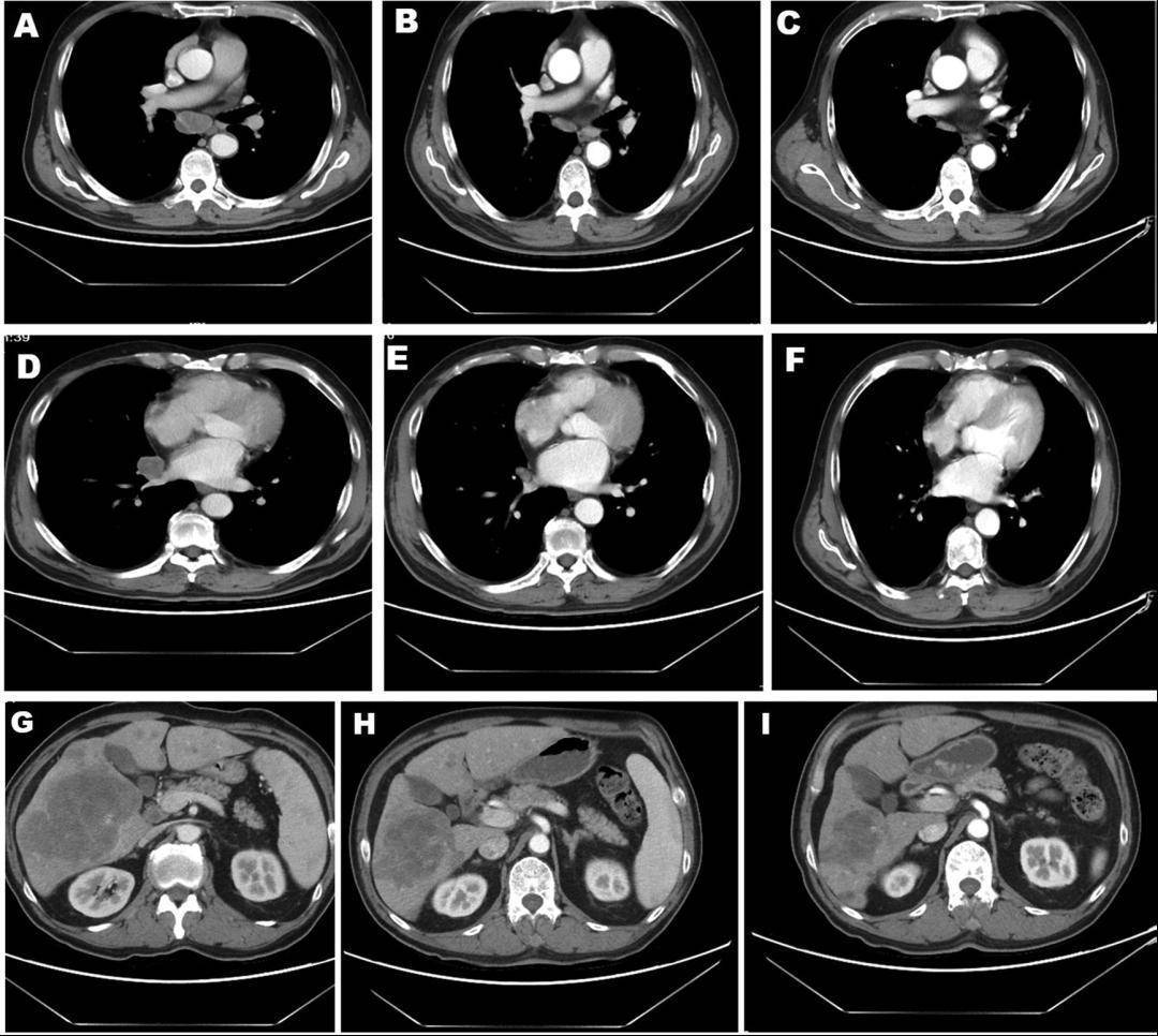 肺癌晚期ct报告单图片图片