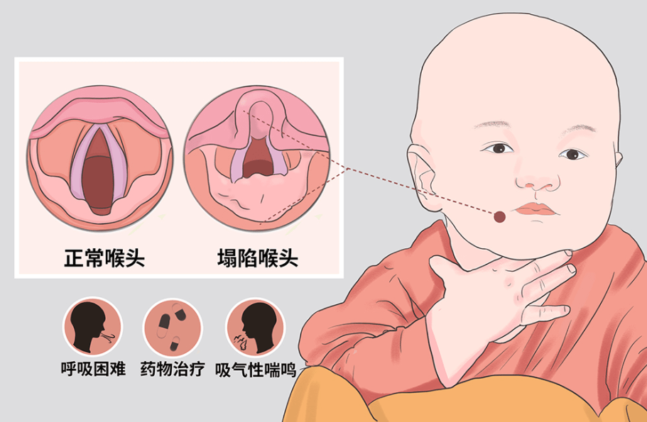 喉喘鸣 来自搜狐网