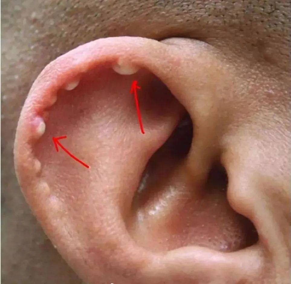 耳轮结节图片图片