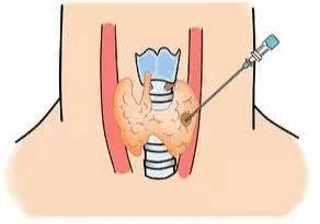 甲状腺结节怕恶变?一针穿刺来明了_超声_颈部_建议