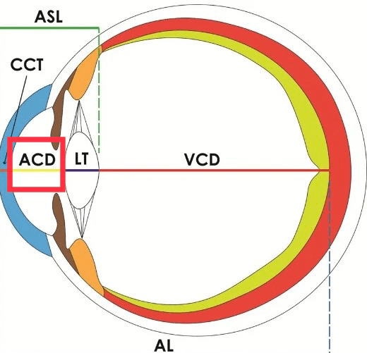 前房深度(anterior chamber depth,acd):前房由角膜