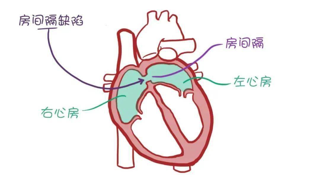 一把小伞封住心脏缺口, 首例房间隔缺损封堵术补心成功