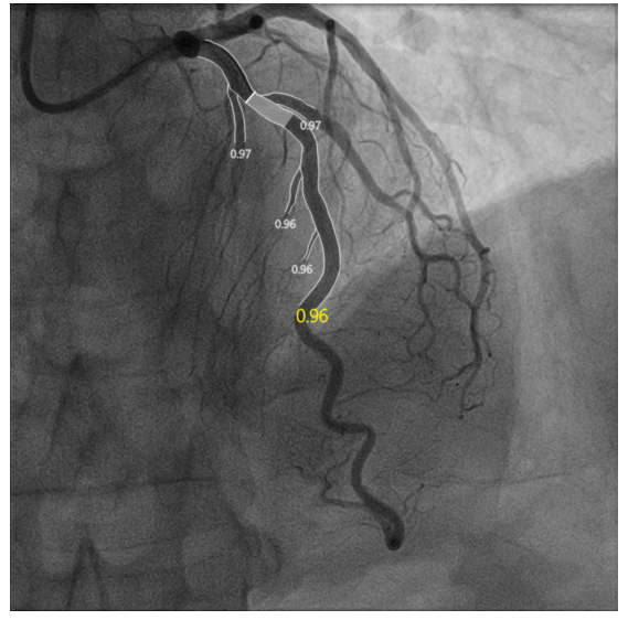 海神之戟,克难攻坚——"斜面旋切"棘突球囊导管减少斑块位移,助力开口