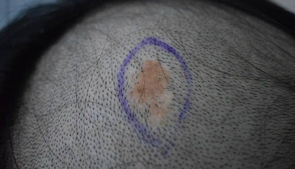 一种以皮脂腺增生为主的发育异常,常在出生时或出生后不久发生.
