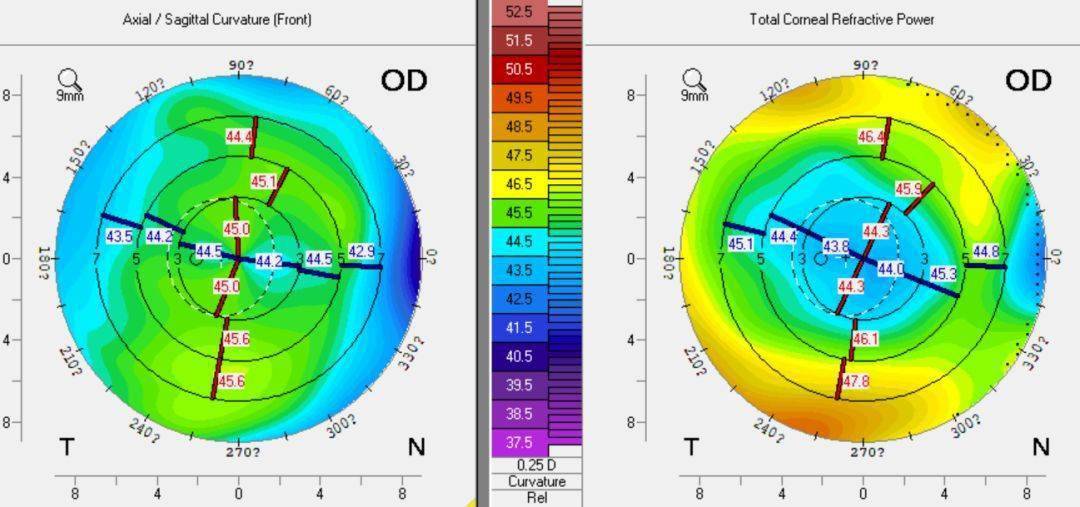 多维度解读角膜曲率