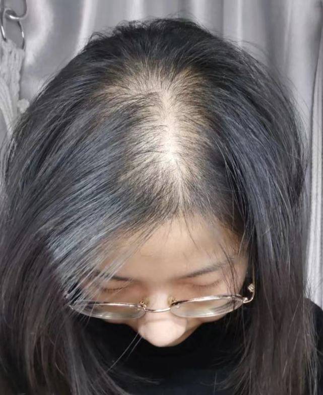 多年顽固脱发成功长出新发,我都做了些什么?纯分享!_头皮_按摩_头顶