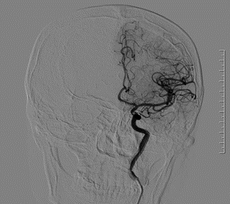 病例赏析|neuroform ez支架辅助栓塞左侧颈内动脉后交通段动脉瘤_患者