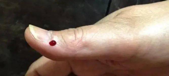 前天咱们讲了,阳了之后发烧,可以在少商,商阳点刺放血,其实这个方法对