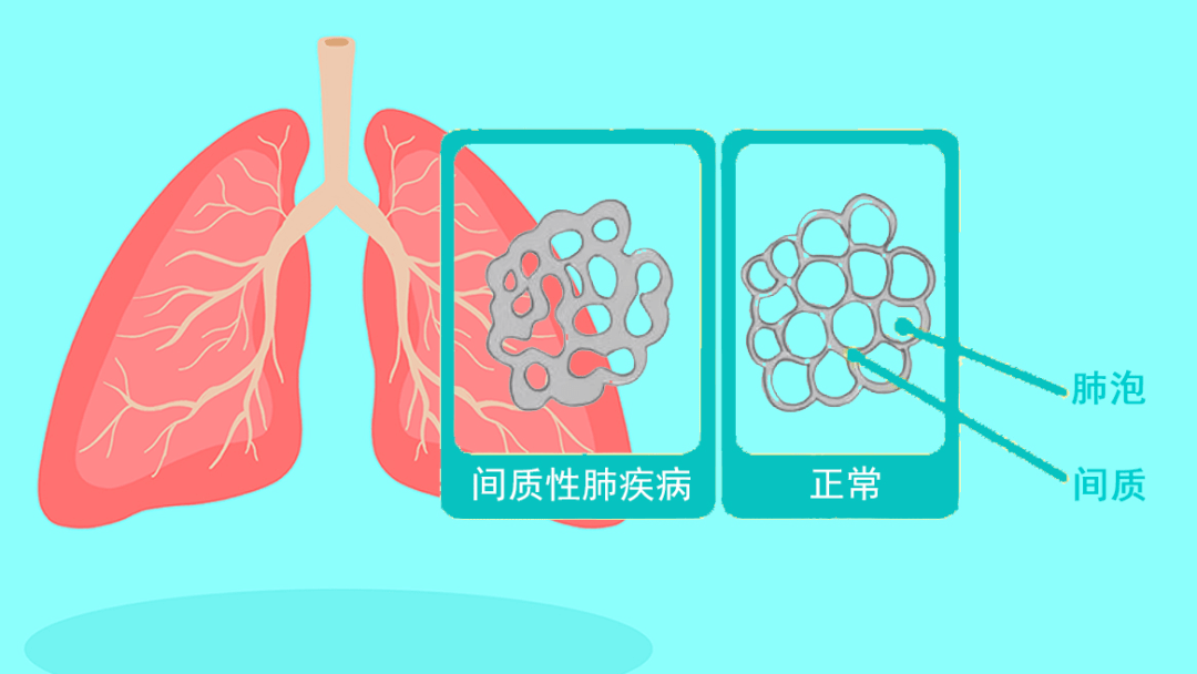 肺泡炎症和间质纤维化为基本病理病变