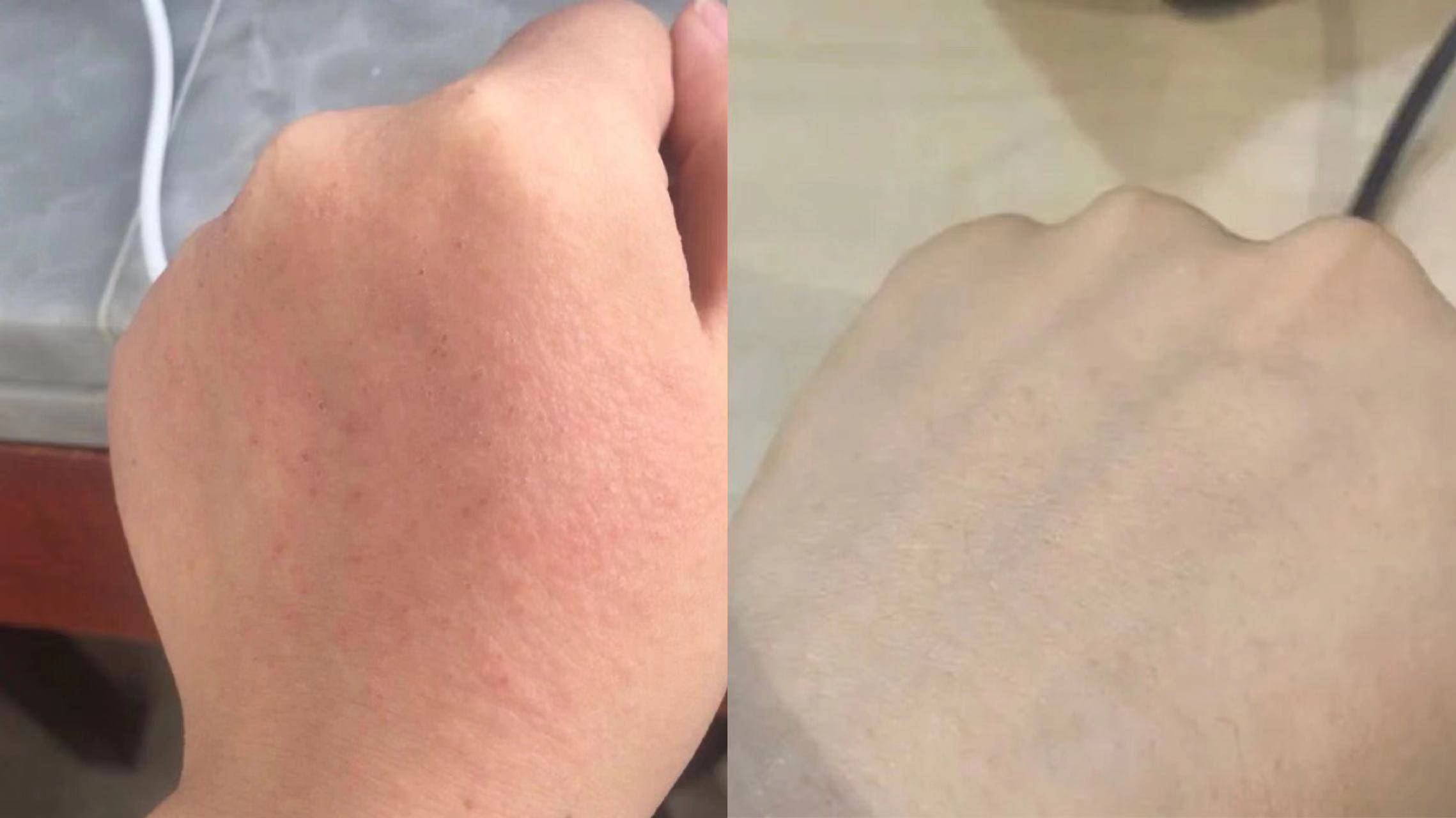 用377身体乳过敏起疹子的简单介绍