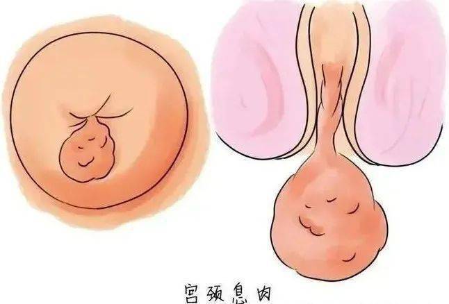 宫颈息肉图片症状图片