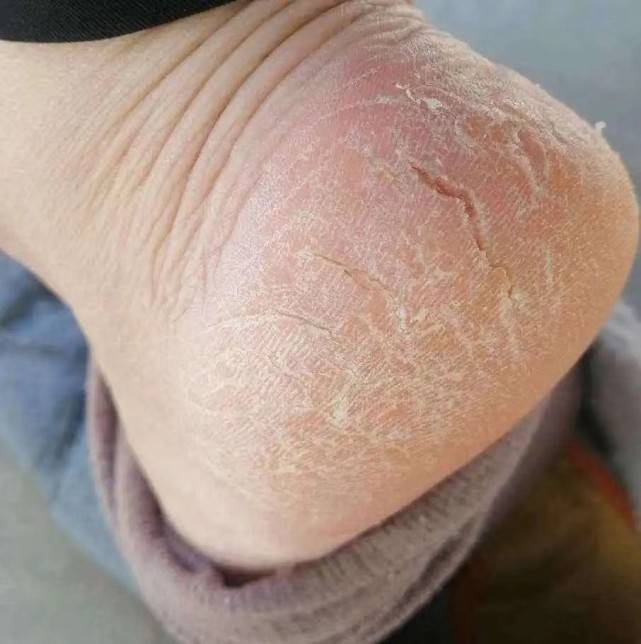 脚后跟反复干裂,流血!那你是没用对方法,这招才对症!_裂口_效果_家务