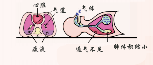 俯卧位通气流程图图片