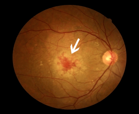 67眼底一张照,眼病早知道!11种常见眼底病,你都了解了吗?