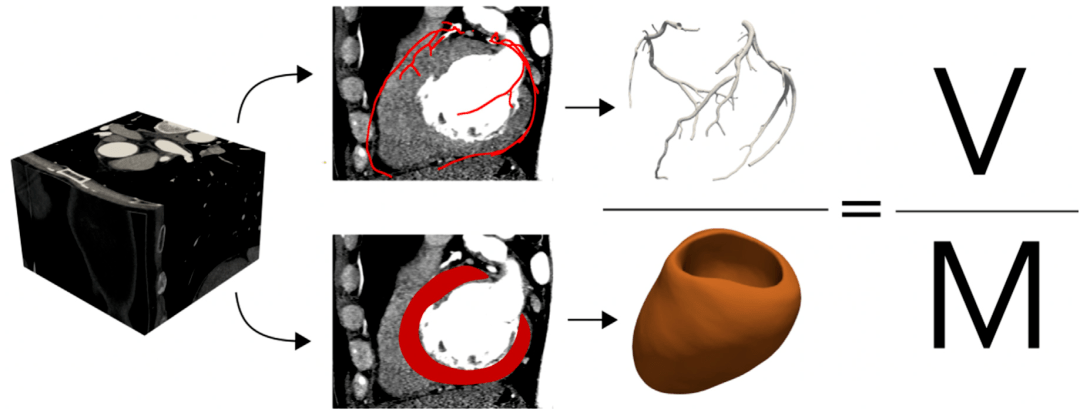 如何快速计算冠状动脉体积与心肌质量比（V/M）