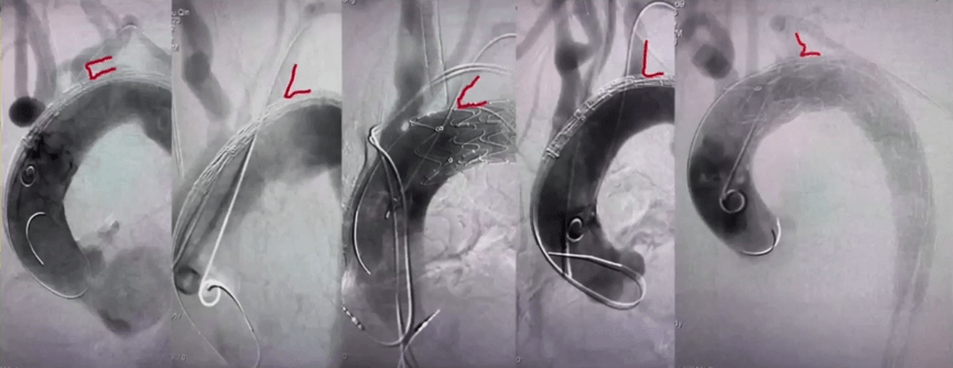 cec 2022|方欣:tevar术中针刺原位开窗lsa重建的陷阱与技巧_主动脉