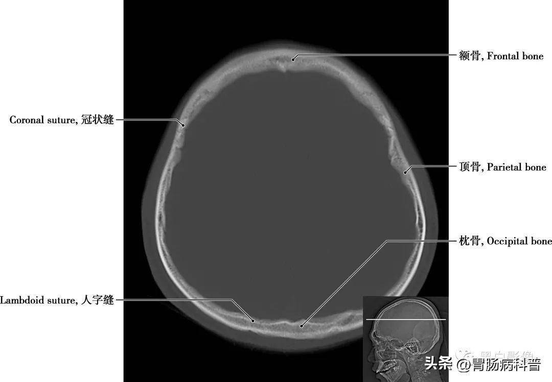 詳細標註版——顱腦ct正常解剖圖譜_中央_小腦_纖維