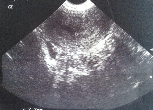 正常的超声影像葡萄胎的超声影像超声可见子宫呈蜂窝状,且血hcg持续