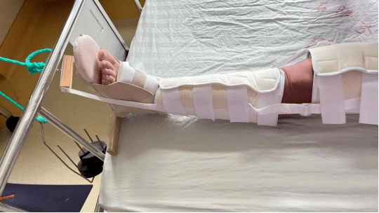 石狮市总医院骨科创新改良下肢牵引带