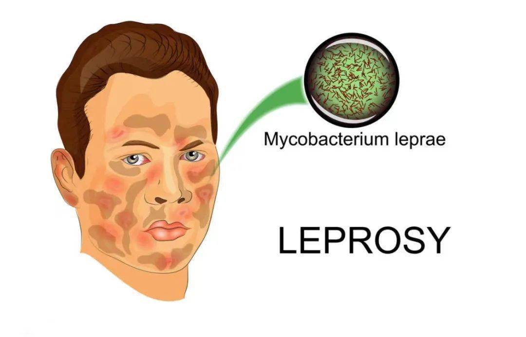 29"世界防治麻风病日"丨弘扬时代精神,消除麻风危害_患者_皮肤_杆菌