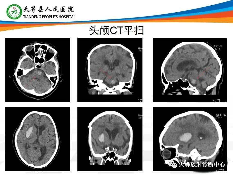 脑干,基底节血肿 脑梗塞(危急值报告)_检查_诊断_患者