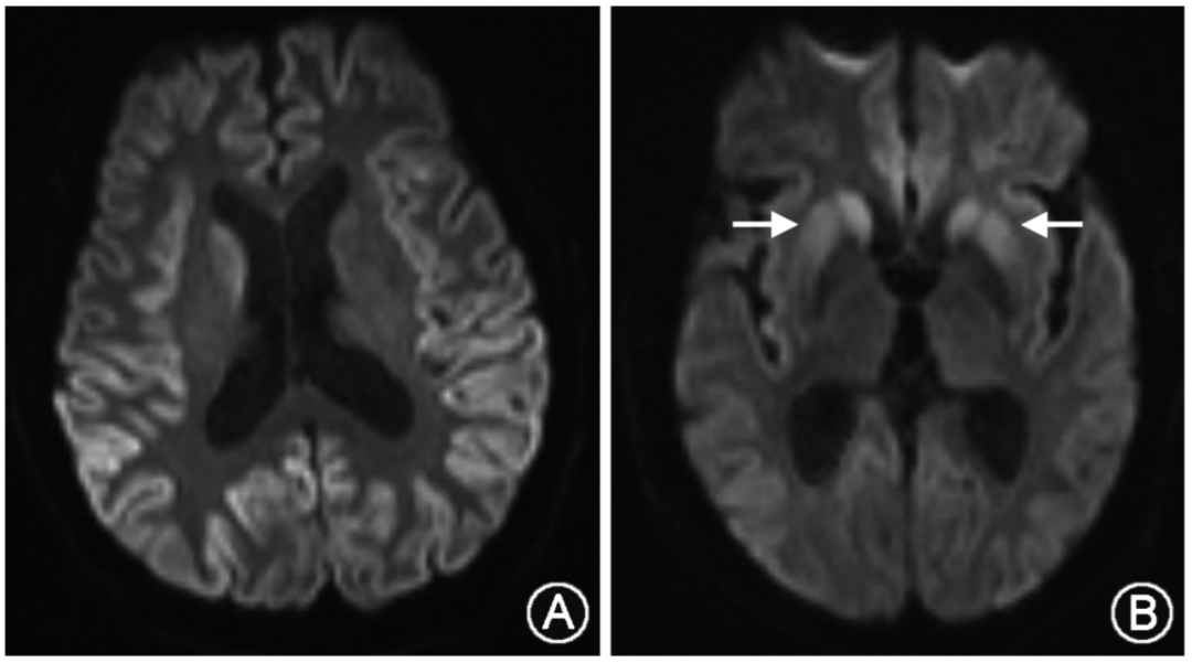 适合中国人的克-雅病诊断「指南发布」(2021)_症状_疾病_病患者