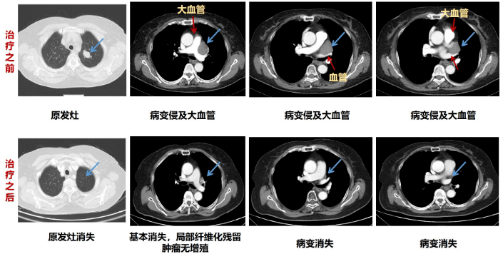 小细胞肺癌不能手术，近70岁也活过3年了！