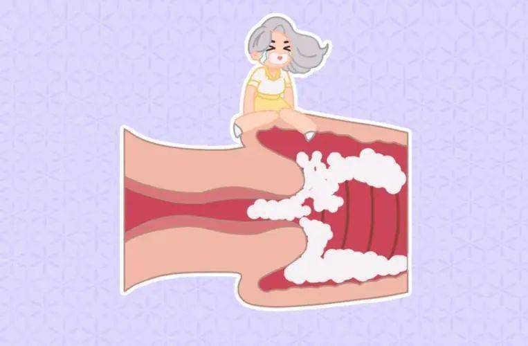霉菌性阴道炎是什么鬼?怎么才能好?_治疗_内裤_炎症