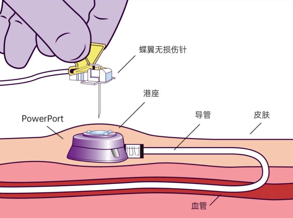 输液港取出术图片