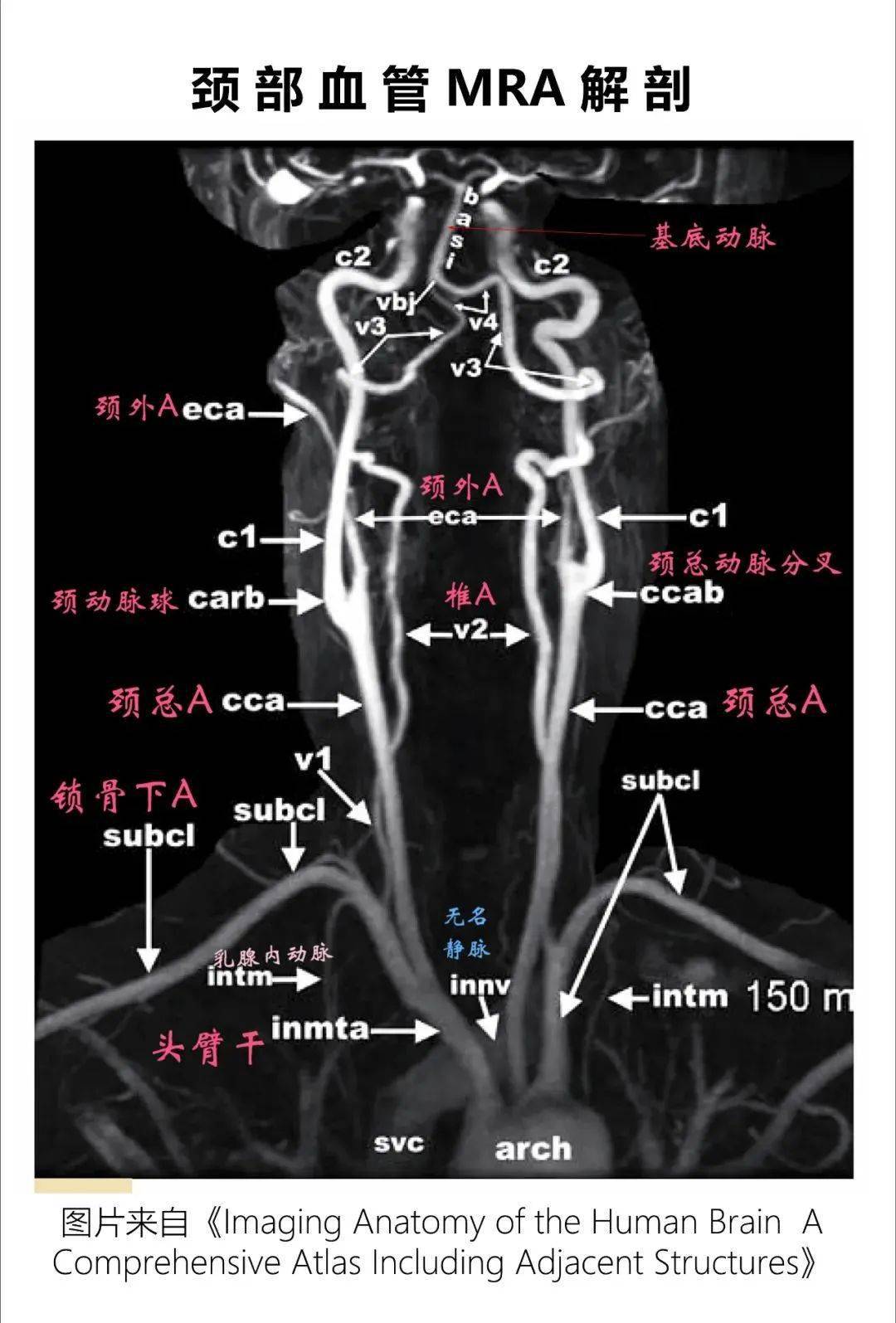 颈内动脉走行图图片