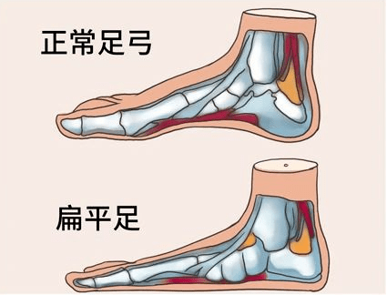 扁平足能否参军?