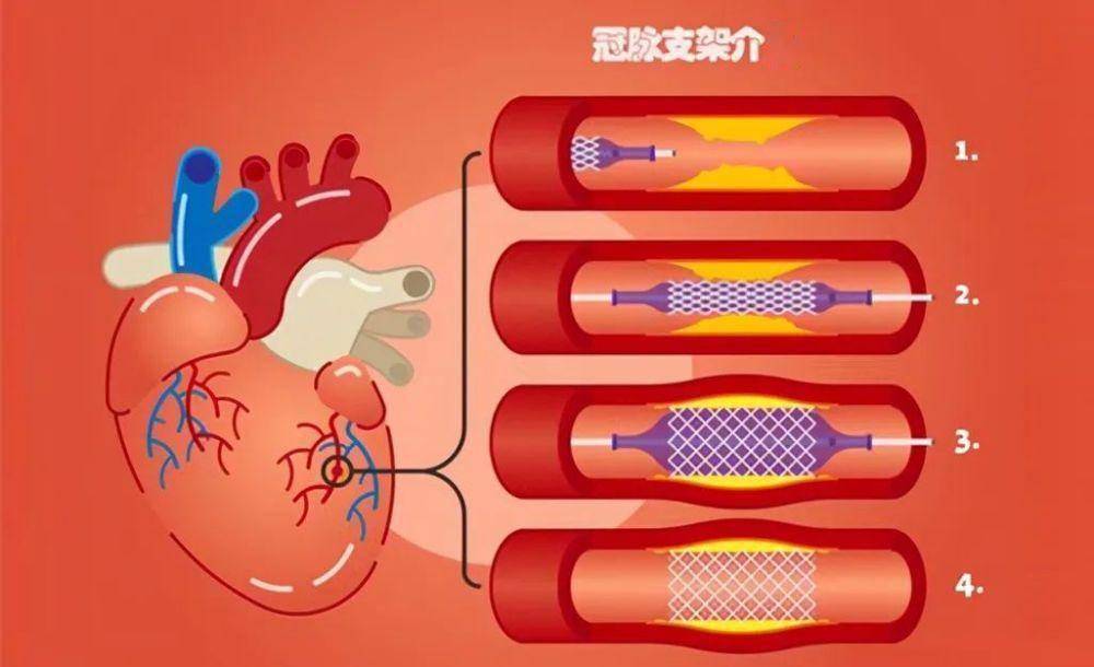 心脏支架属于"缺德害人",装上人就完了?