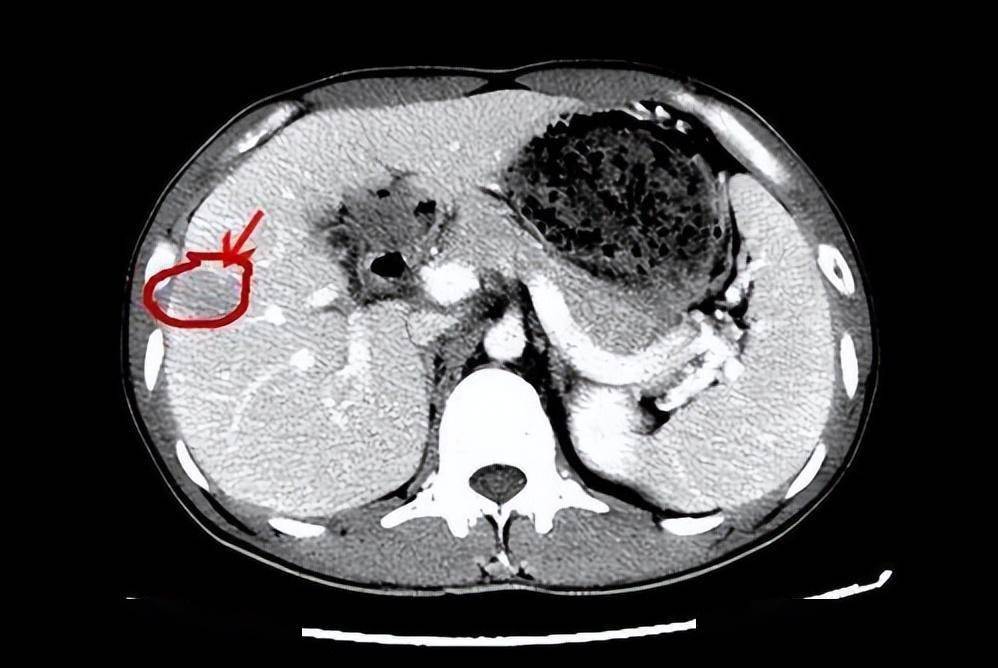 肝肿瘤ct显示图片图片